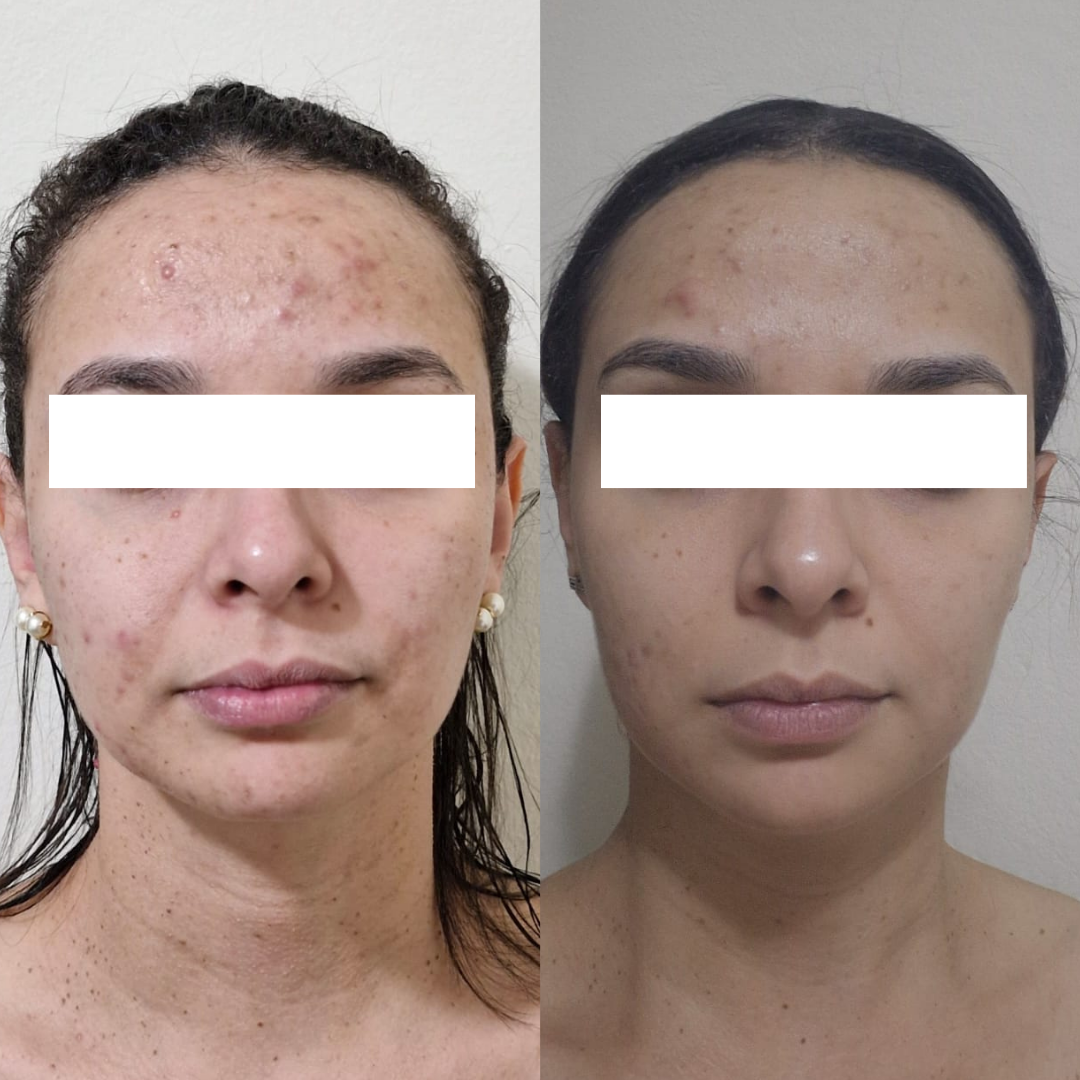 Resultado 6 de acompanhamento personalizado de skincare