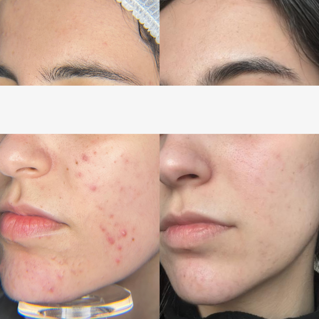 Resultado 2 de acompanhamento personalizado de skincare