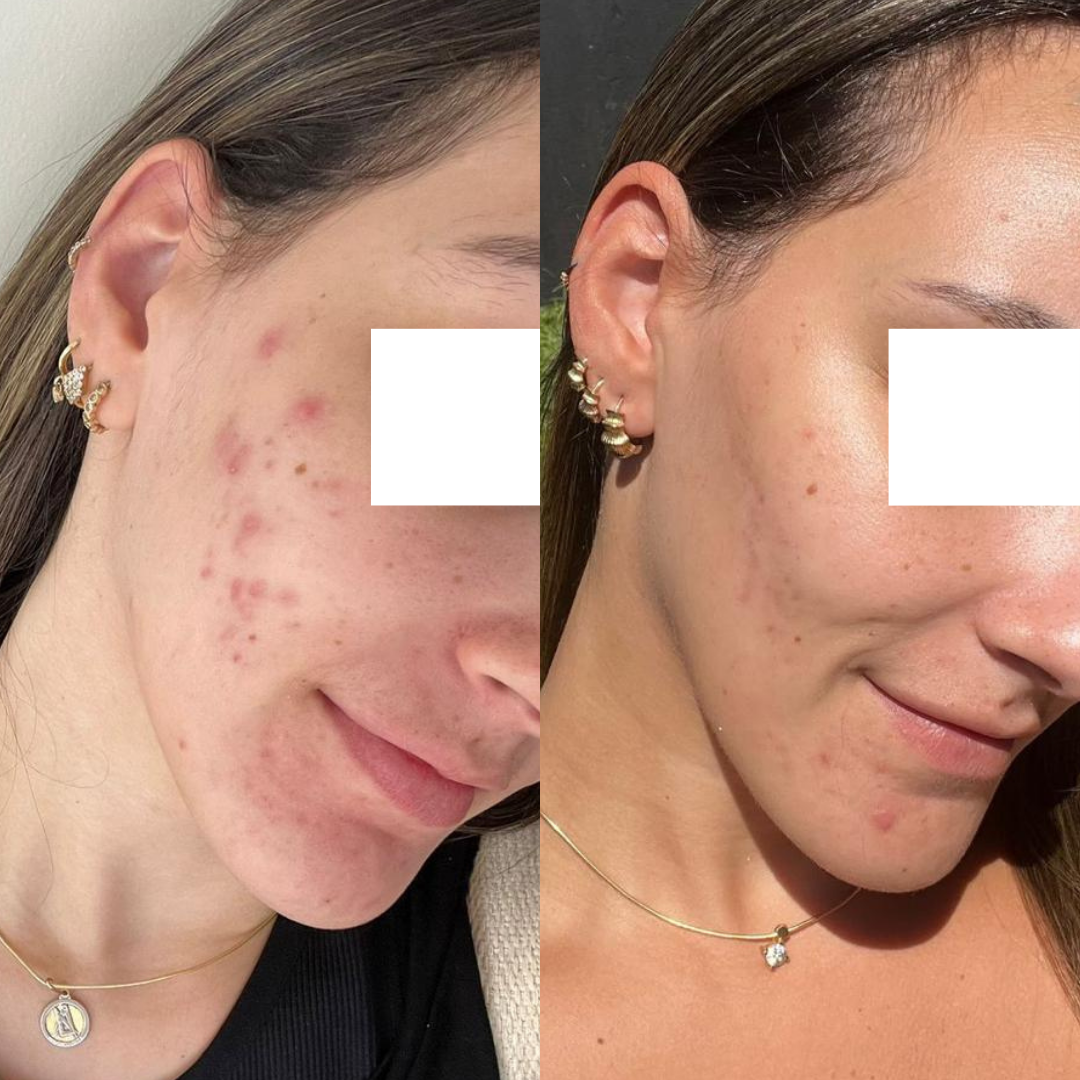 Resultado 10 de acompanhamento personalizado de skincare