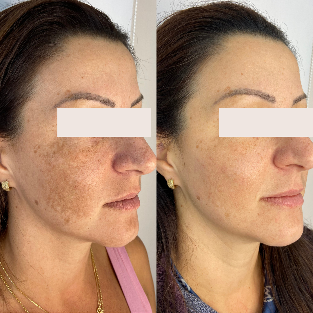 Resultado 4 de acompanhamento personalizado de skincare