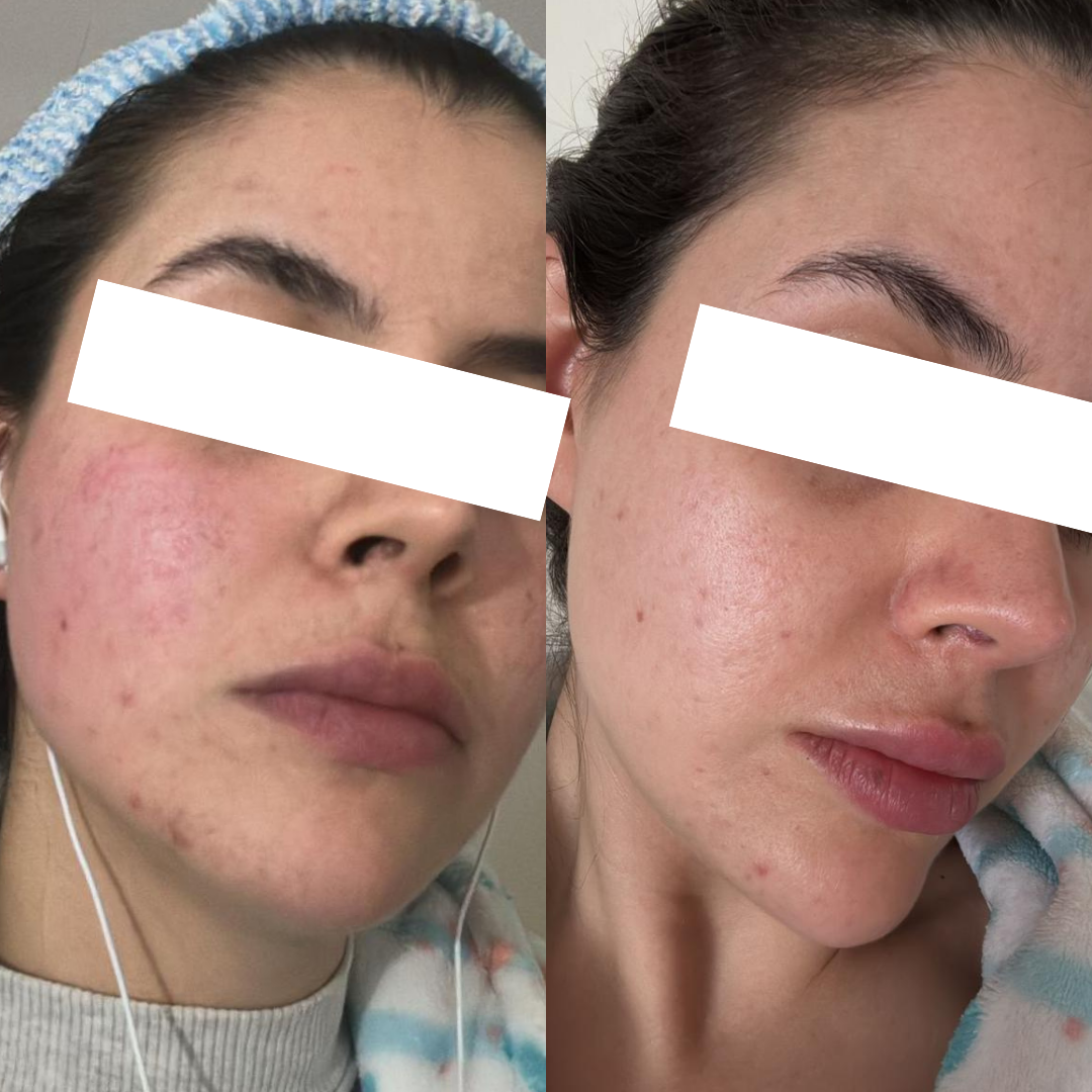 Resultado 1 de acompanhamento personalizado de skincare