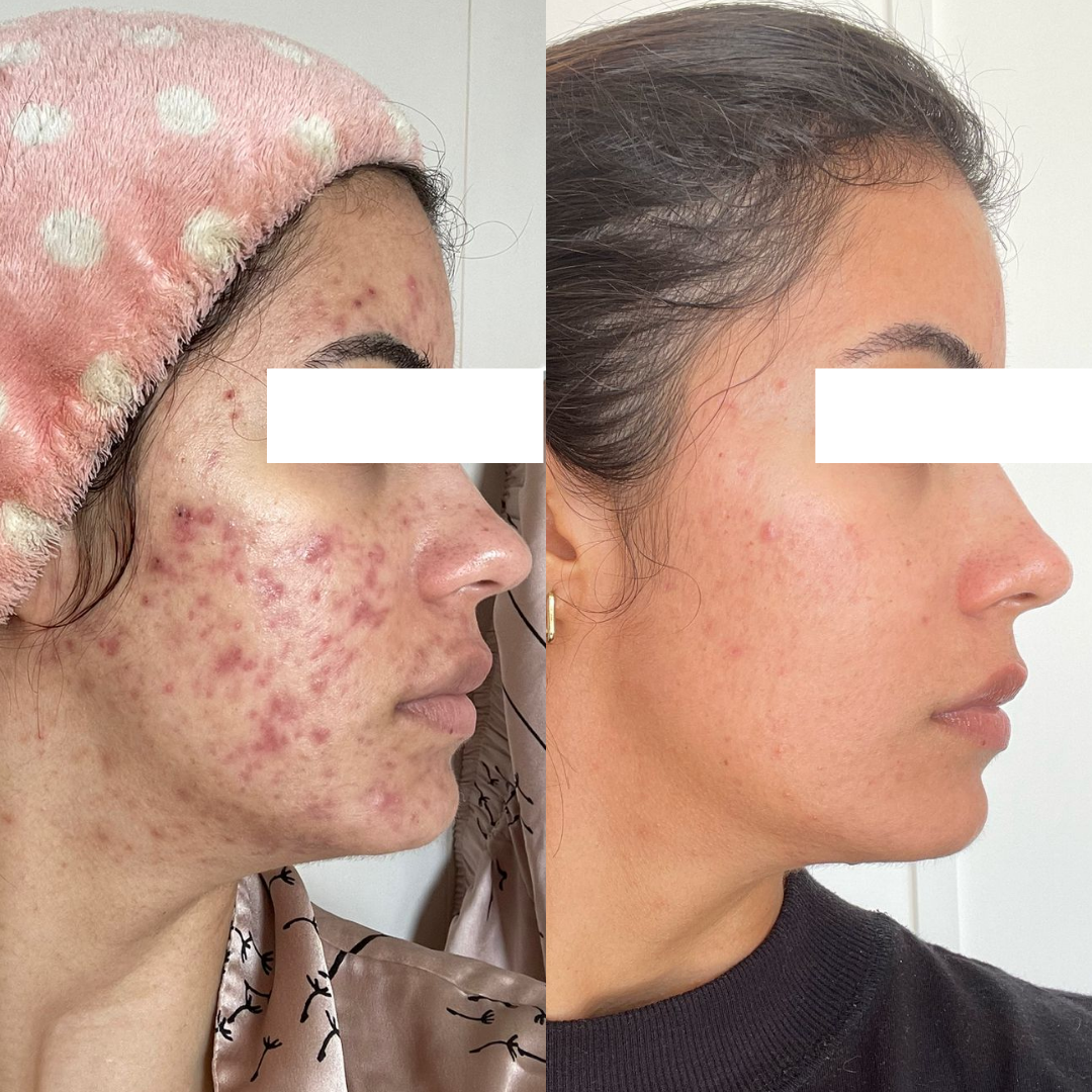 Resultado 5 de acompanhamento personalizado de skincare