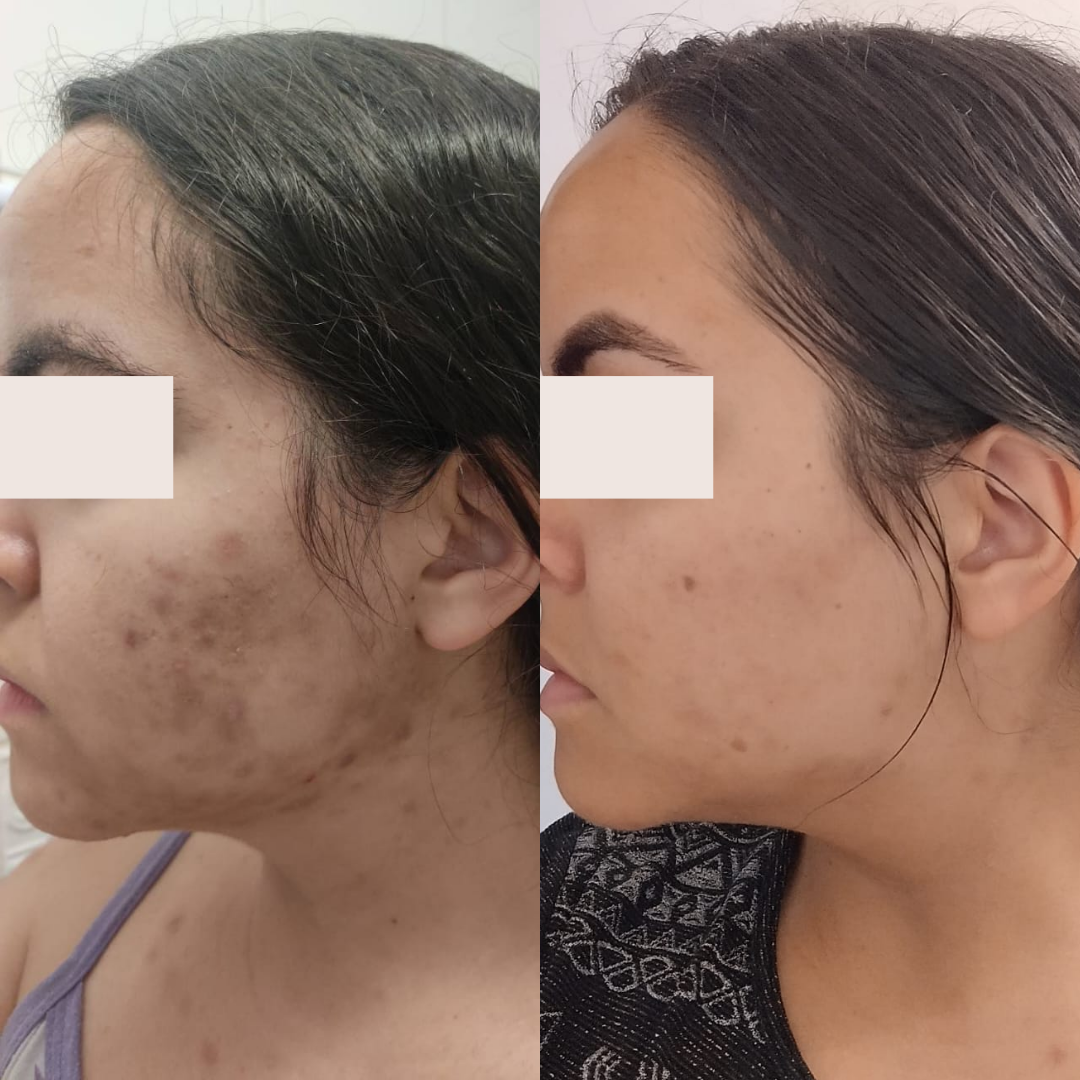 Resultado 3 de acompanhamento personalizado de skincare